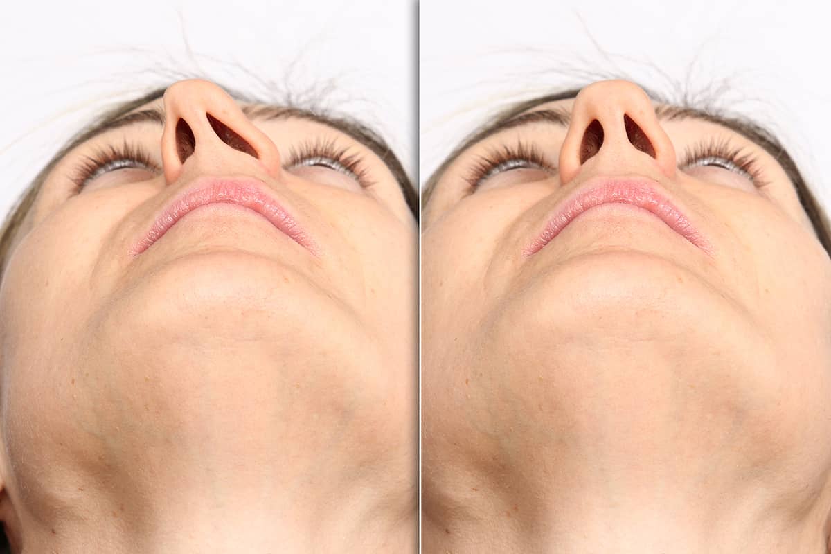 Septoplastika nədir?