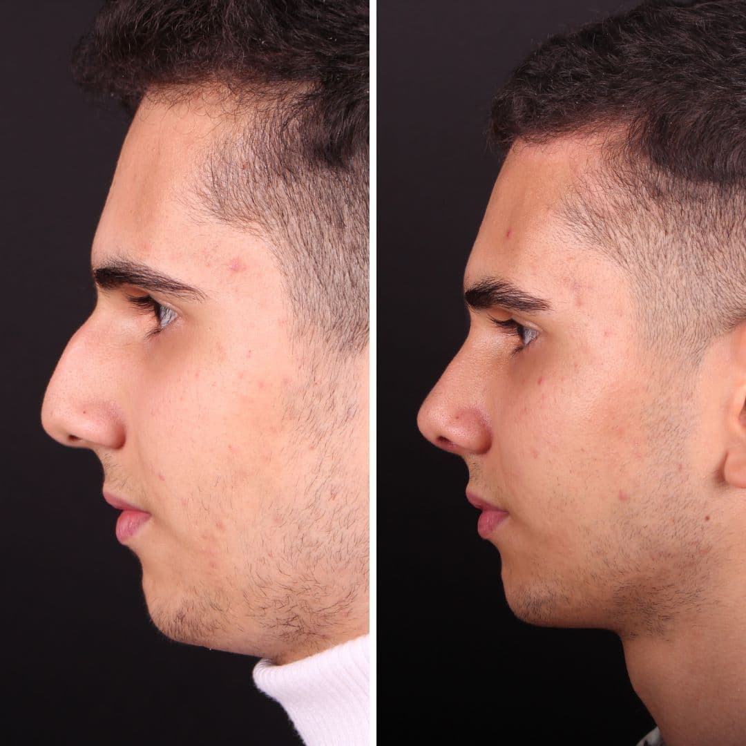 Əməliyyat əvvəli və sonrası